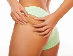 type de cellulite